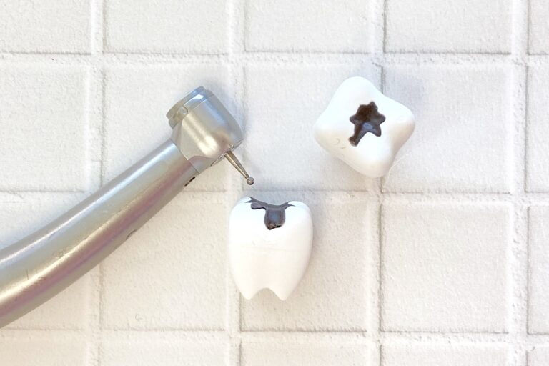 虫歯が嫌な人必見！【虫歯になりやすい歯】とは？